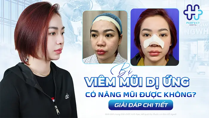 Bị Viêm Mũi Dị Ứng Có Nâng Mũi Được Không? Giải Đáp Chi Tiết