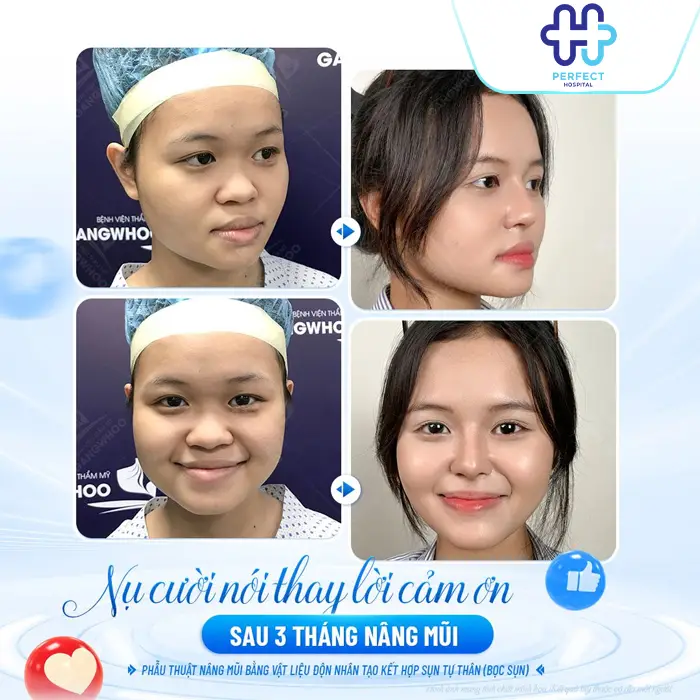 Các Dáng Mũi Nâng Đẹp Nhất Hiện Nay – Nâng Mũi Kiểu Gì Phù Hợp