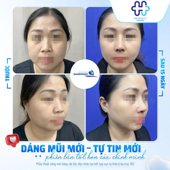 Các Dáng Mũi Nâng Đẹp Nhất Hiện Nay – Nâng Mũi Kiểu Gì Phù Hợp