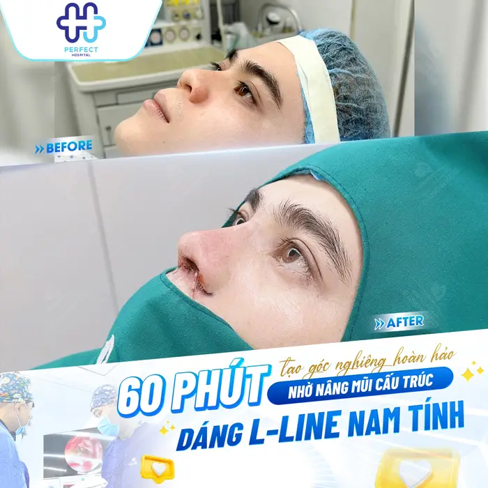 Các Dáng Mũi Nâng Đẹp Nhất Hiện Nay – Nâng Mũi Kiểu Gì Phù Hợp