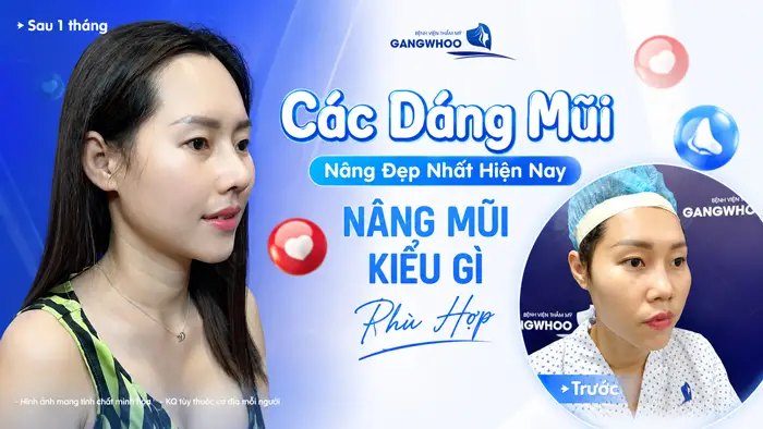Các Dáng Mũi Nâng Đẹp Nhất Hiện Nay – Nâng Mũi Kiểu Gì Phù Hợp