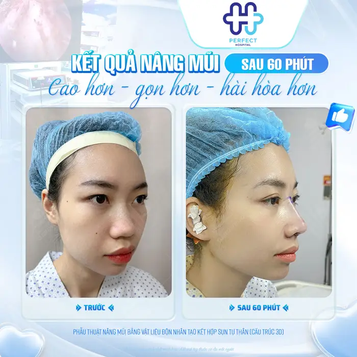 Tìm hiểu các phương pháp nâng mũi hiện nay ? Nên chọn loại nào phù hợp?