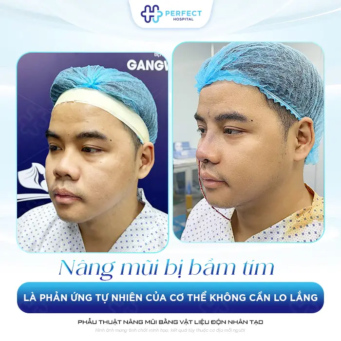Cách Giảm Bầm Tím Sau Nâng Mũi Hiệu Quả Và An Toàn Nhanh Nhất
