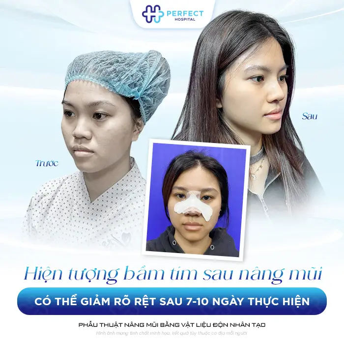 Cách Giảm Bầm Tím Sau Nâng Mũi Hiệu Quả Và An Toàn Nhanh Nhất