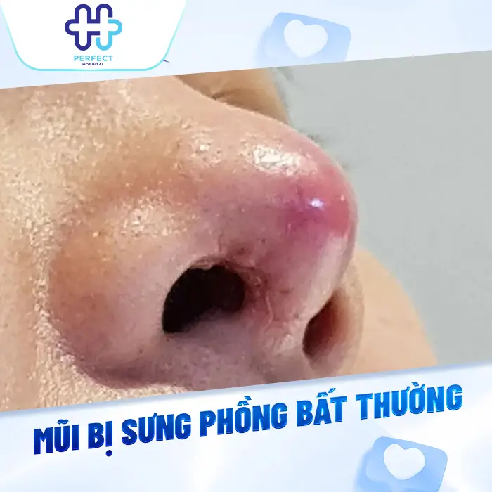 Cách Giảm Sưng Sau Nâng Mũi Hiệu Quả Giúp Mũi Nhanh Vào Form