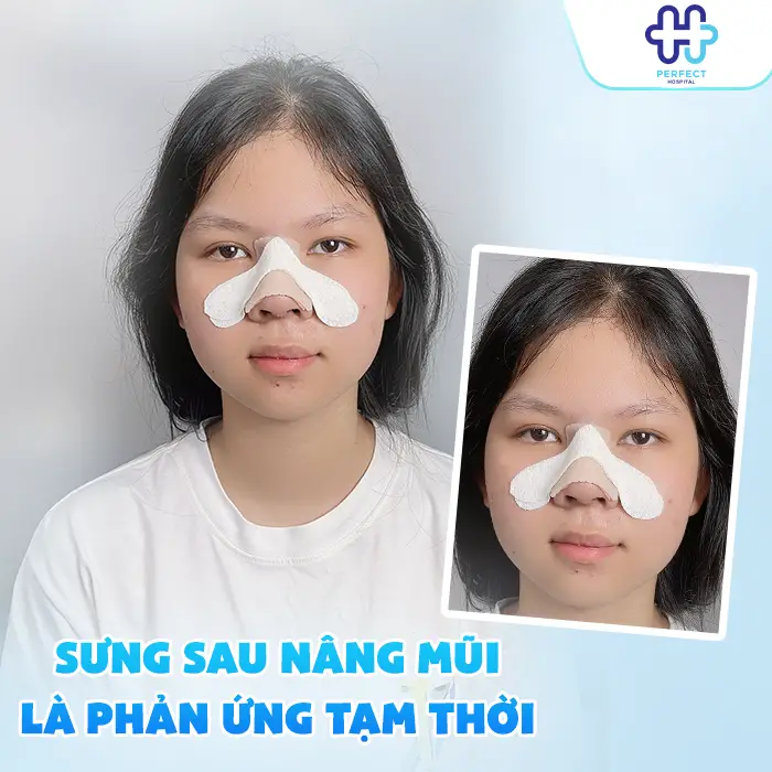 Cách Giảm Sưng Sau Nâng Mũi Hiệu Quả Giúp Mũi Nhanh Vào Form