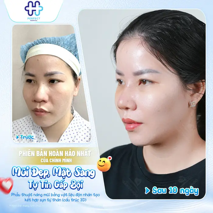 Cách nâng mũi tại nhà có hiệu quả không? Sự thật cần biết