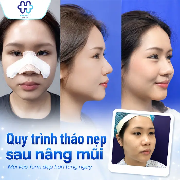 Cách Tháo Nẹp Nâng Mũi Đúng Cách Và Những Lưu Ý Quan Trọng