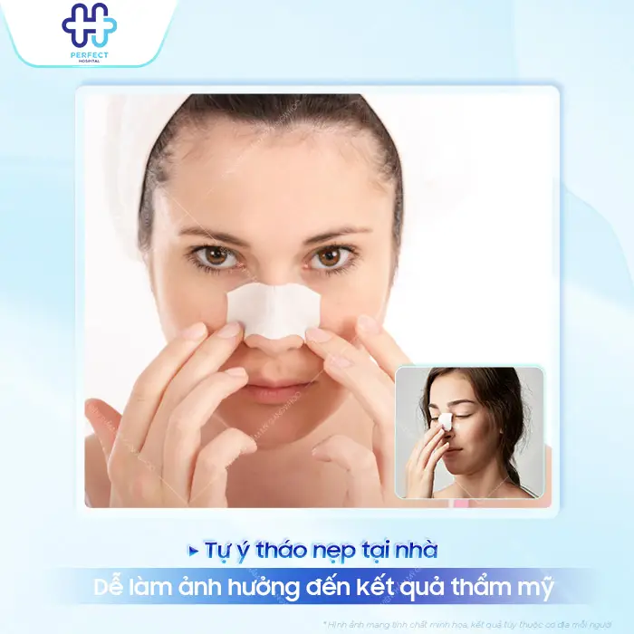 Cách Tháo Nẹp Nâng Mũi Đúng Cách Và Những Lưu Ý Quan Trọng