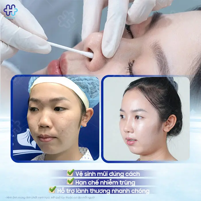 Cách Vệ Sinh Mũi Sau Khi Nâng Đúng Cách, Nhanh Hồi Phục