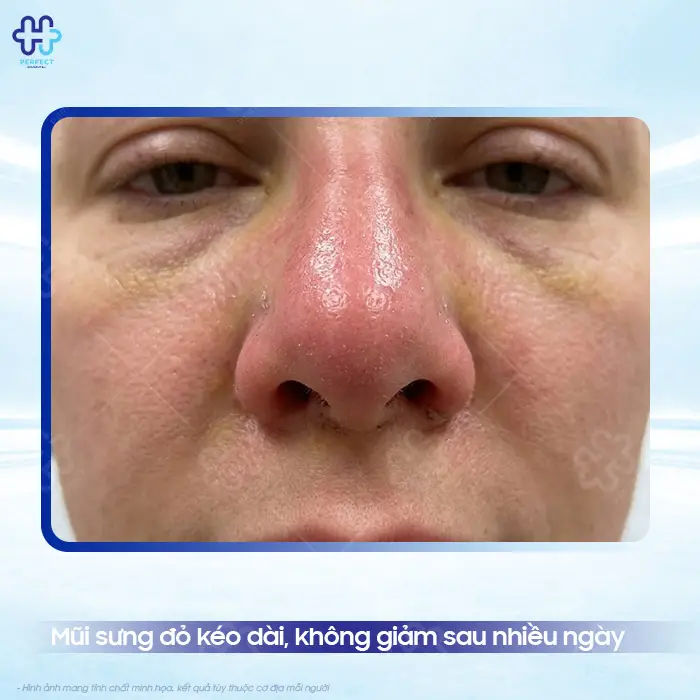 Cách Vệ Sinh Mũi Sau Khi Nâng Đúng Cách, Nhanh Hồi Phục