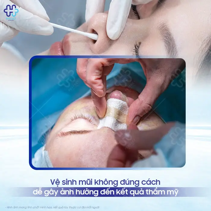 Cách Vệ Sinh Mũi Sau Khi Nâng Đúng Cách, Nhanh Hồi Phục
