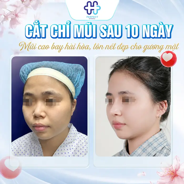 Cắt Chỉ Nâng Mũi Có Đau Không? Giải Đáp Chi Tiết Từ Bác Sĩ