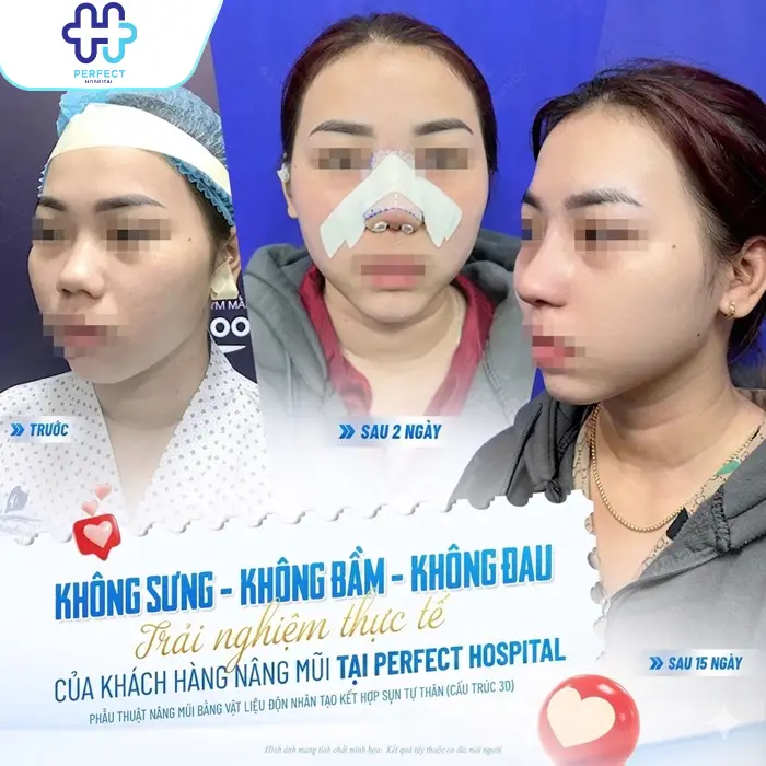 Chăm Sóc Sau Nâng Mũi Đúng Cách Giúp Mũi Nhanh Đẹp Tự Nhiên