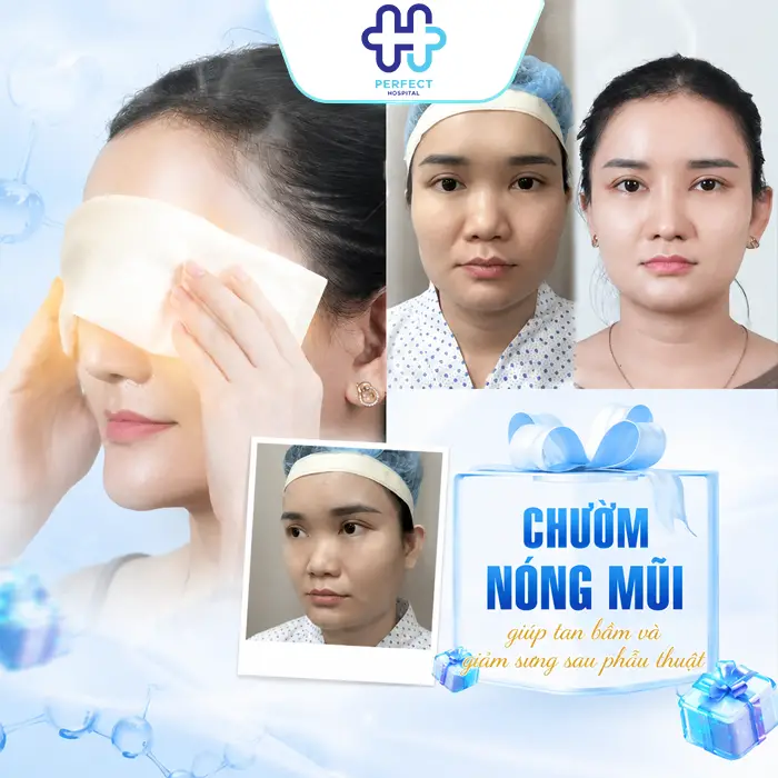 Chườm Nóng Sau Khi Nâng Mũi: Cách Thực Hiện Đúng Giúp Giảm Sưng