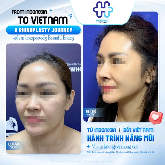 Cơ Địa Sẹo Lồi Có Nâng Mũi Được Không? Cách Hạn Chế Sẹo