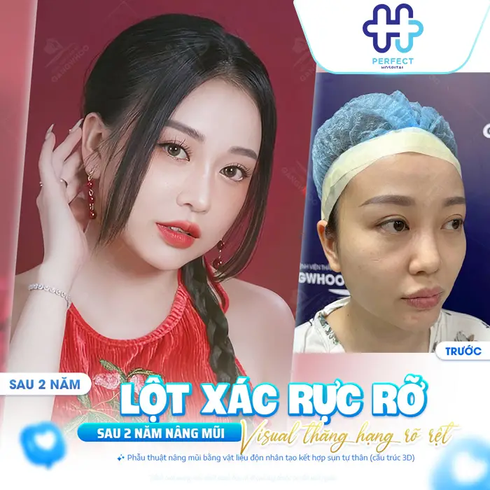 Cơ Địa Sẹo Lồi Có Nâng Mũi Được Không? Cách Hạn Chế Sẹo