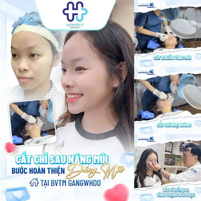 Cơ Địa Sẹo Lồi Có Nâng Mũi Được Không? Cách Hạn Chế Sẹo