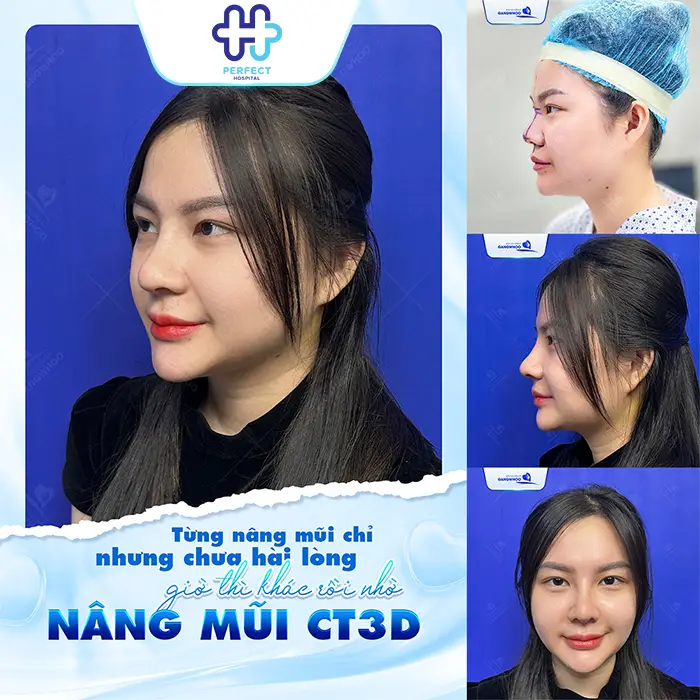 Cơ Địa Sẹo Lồi Có Nâng Mũi Được Không? Cách Hạn Chế Sẹo