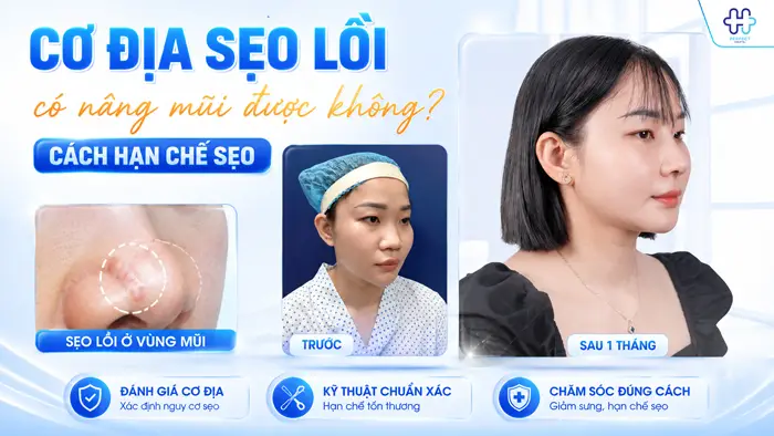 Cơ Địa Sẹo Lồi Có Nâng Mũi Được Không? Cách Hạn Chế Sẹo