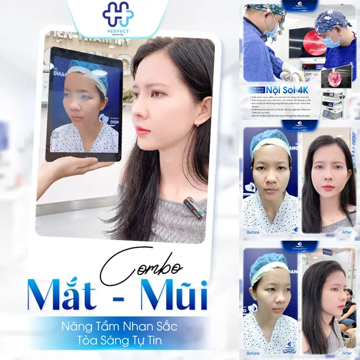 Có Nên Nâng Mũi Và Cắt Mí Mắt Cùng Lúc Không? Giải Đáp Chi Tiết