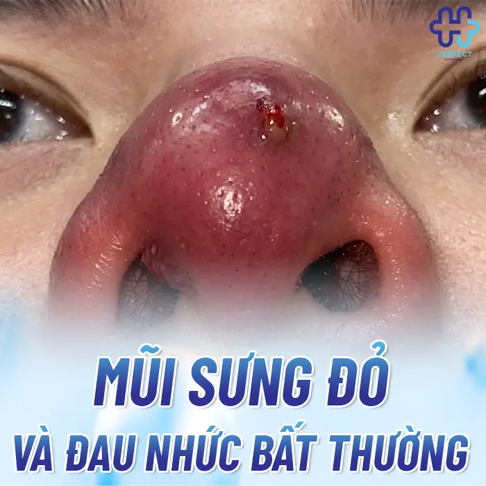 Dấu Hiệu Dị Ứng Chất Liệu Khi Nâng Mũi Và Cách Xử Lý An Toàn