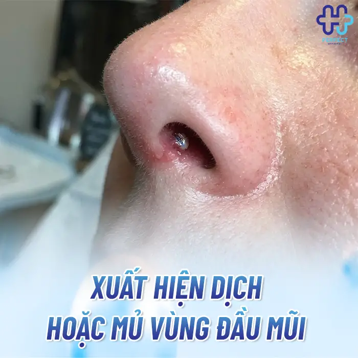 Dấu Hiệu Dị Ứng Chất Liệu Khi Nâng Mũi Và Cách Xử Lý An Toàn