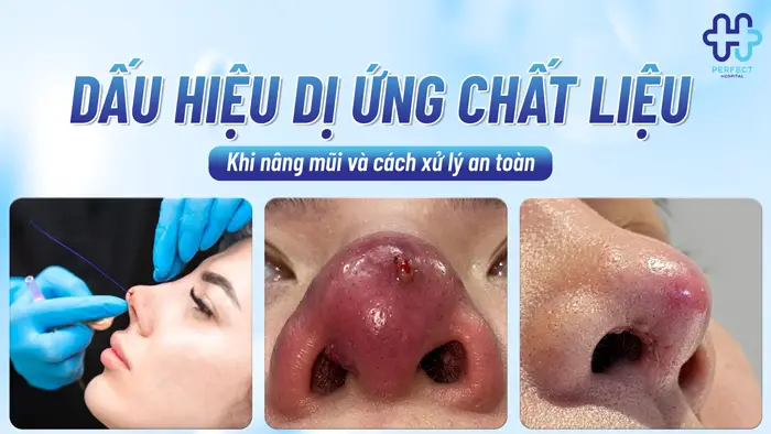 Dấu Hiệu Dị Ứng Chất Liệu Khi Nâng Mũi Và Cách Xử Lý An Toàn