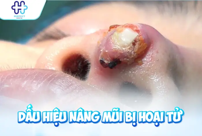 Dấu Hiệu Nâng Mũi Bị Hoại Tử: Nhận Biết Sớm Để Xử Lý Kịp Thời