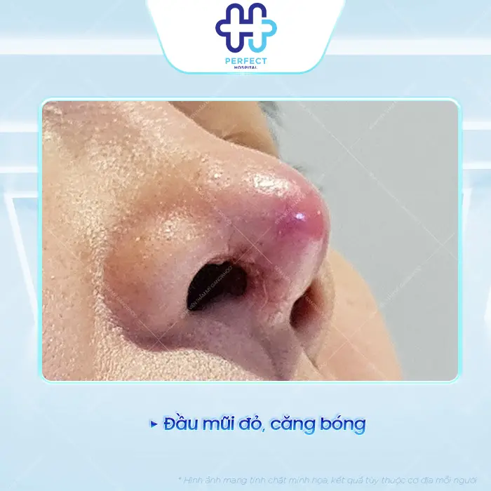 Dấu Hiệu Nhận Biết Mũi Tụt Sụn Sau Nâng Và Cách Xử Lý An Toàn