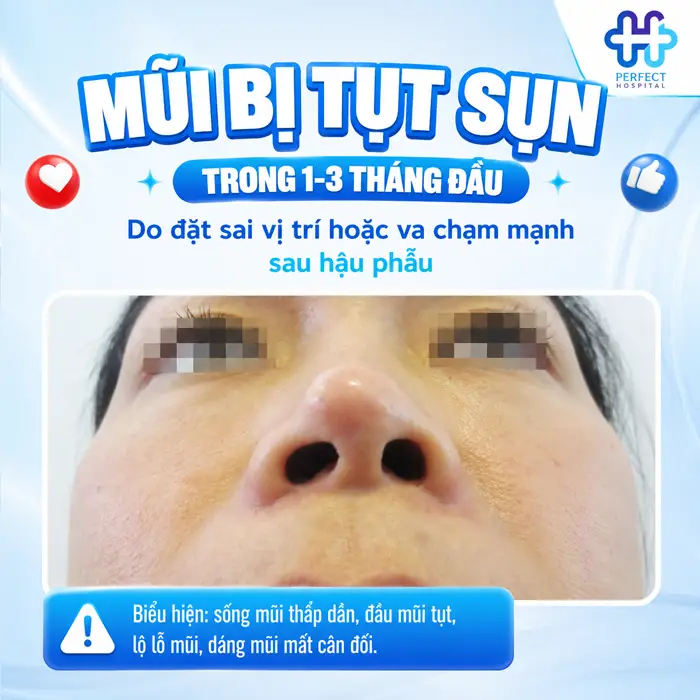 Dấu Hiệu Nhận Biết Mũi Tụt Sụn Sau Nâng Và Cách Xử Lý An Toàn