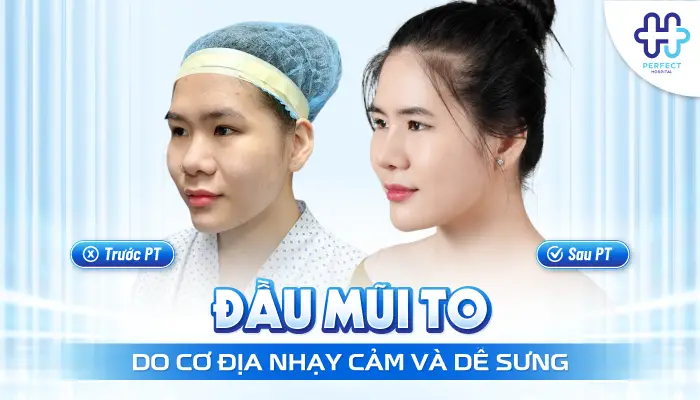 Đầu Mũi To Sau Khi Nâng: Nguyên Nhân Và Cách Xử Lý Hiệu Quả