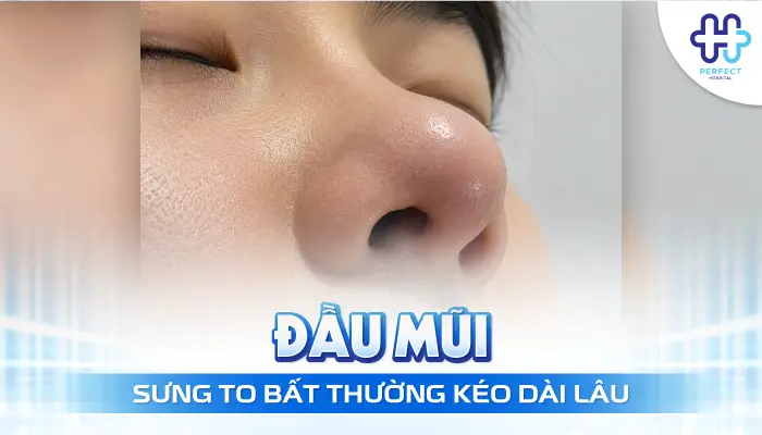 Đầu Mũi To Sau Khi Nâng: Nguyên Nhân Và Cách Xử Lý Hiệu Quả
