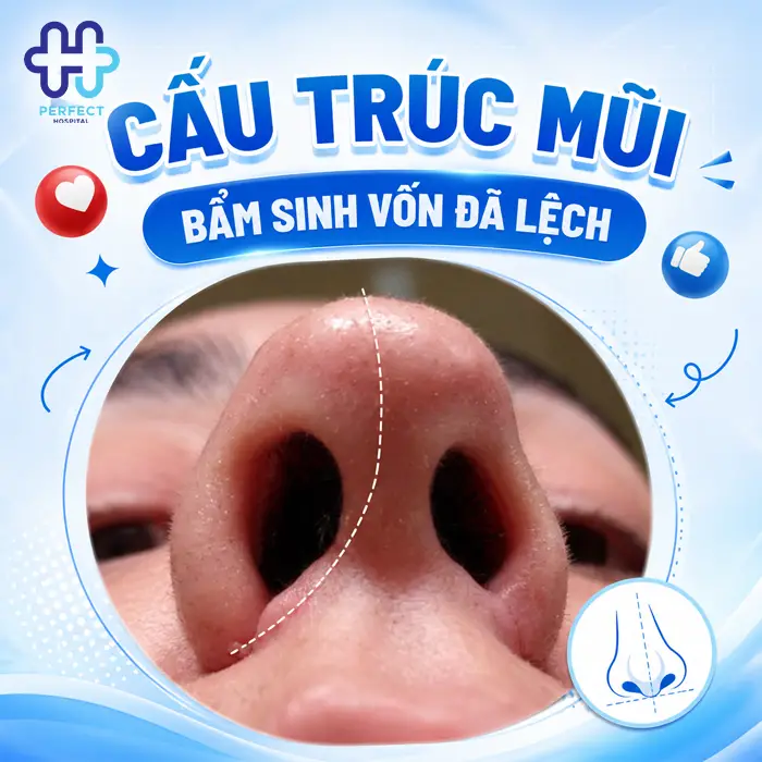 Nguyên Nhân Hai Lỗ Mũi Không Đều Sau Khi Nâng Và Cách Xử Lý