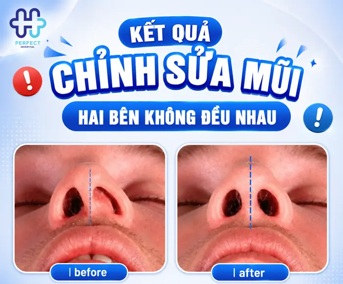 Nguyên Nhân Hai Lỗ Mũi Không Đều Sau Khi Nâng Và Cách Xử Lý