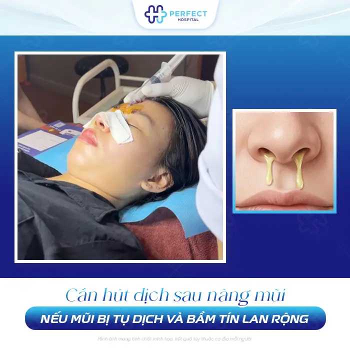 Hút Dịch Sau Nâng Mũi Có Đau Không? Khi Nào Cần Thực Hiện