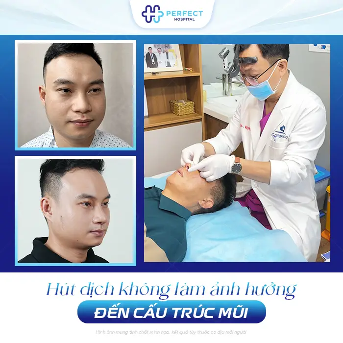 Hút Dịch Sau Nâng Mũi Có Đau Không? Khi Nào Cần Thực Hiện