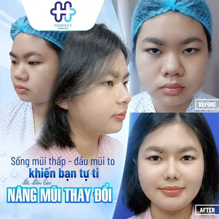 Nâng Mũi Cho Mặt Tròn: Chọn Dáng Mũi Phù Hợp Chuẩn Tỷ Lệ Vàng