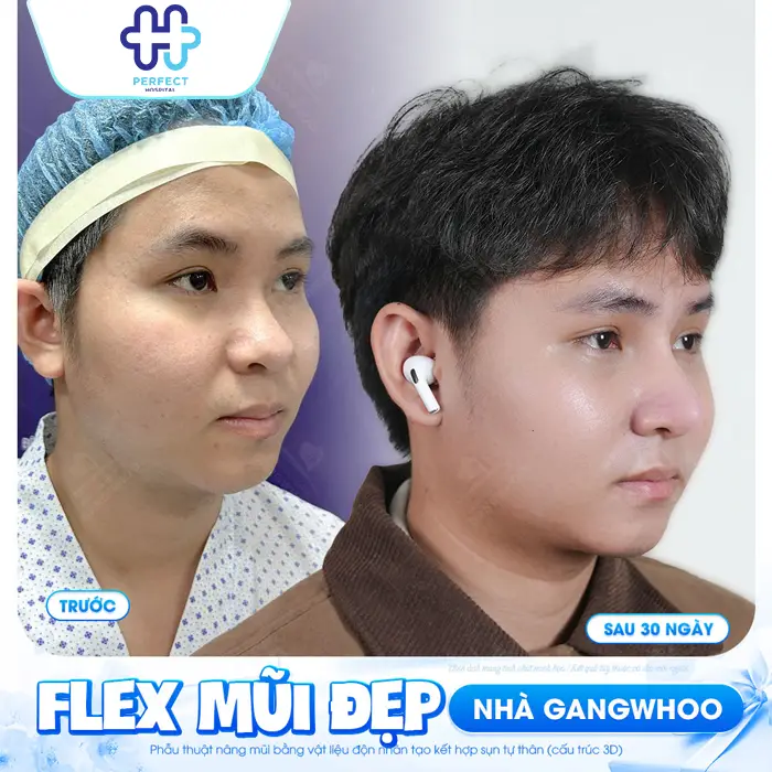 Nâng Mũi Cho Mặt Tròn: Chọn Dáng Mũi Phù Hợp Chuẩn Tỷ Lệ Vàng