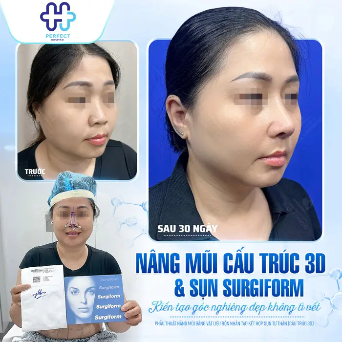 Nâng Mũi Cho Mặt Tròn: Chọn Dáng Mũi Phù Hợp Chuẩn Tỷ Lệ Vàng