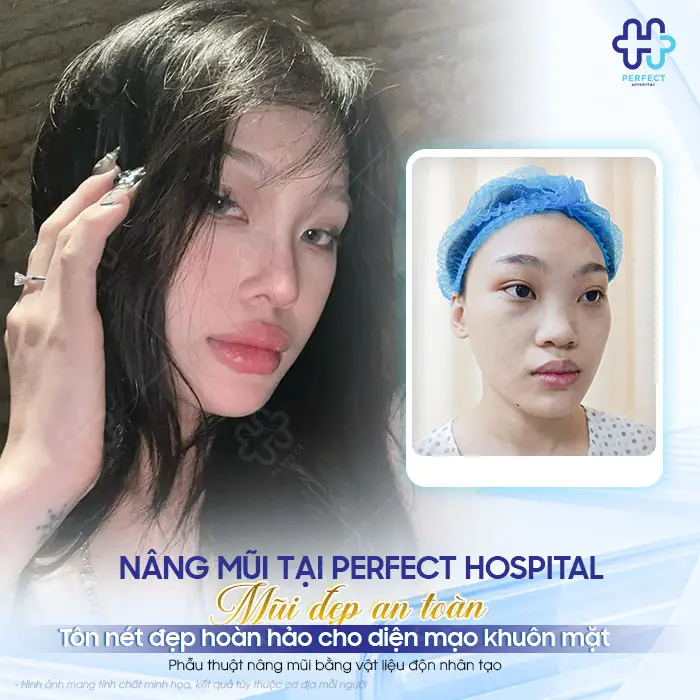 Nâng Mũi Bị Lệch Phải Làm Sao? Nguyên Nhân Và Cách Xử Lý