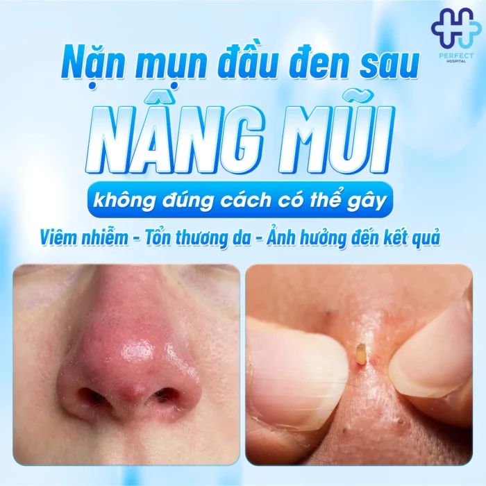 Mụn Đầu Đen Sau Khi Nâng Mũi: Nguyên Nhân Và Cách Xử Lý Hiệu Quả
