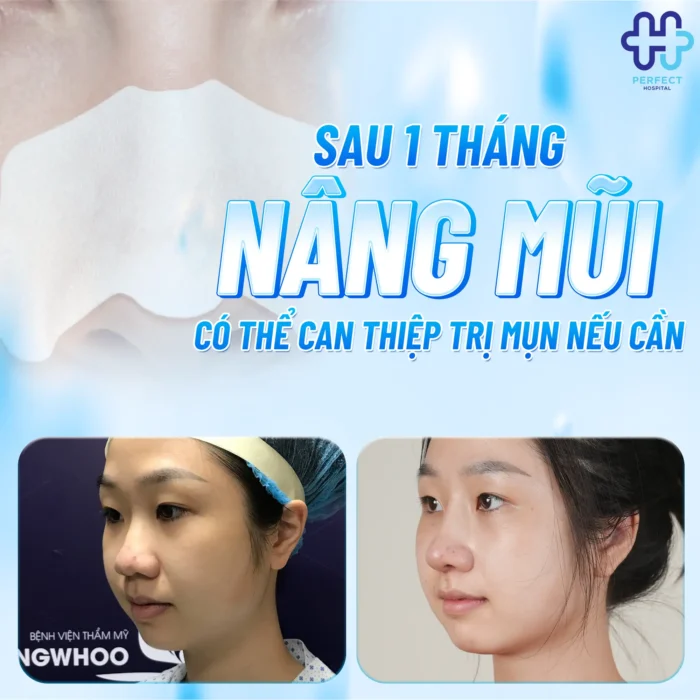 Mụn Đầu Đen Sau Khi Nâng Mũi: Nguyên Nhân Và Cách Xử Lý Hiệu Quả