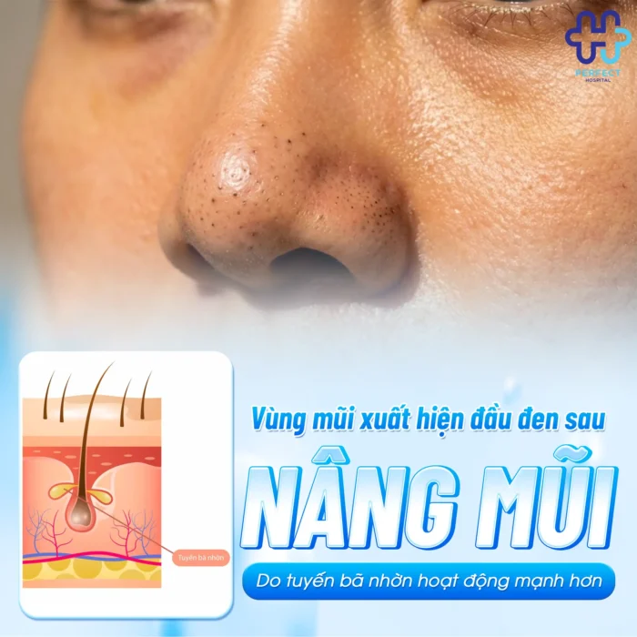 Mụn Đầu Đen Sau Khi Nâng Mũi: Nguyên Nhân Và Cách Xử Lý Hiệu Quả