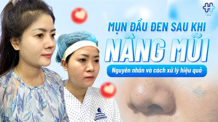 Mụn Đầu Đen Sau Khi Nâng Mũi: Nguyên Nhân Và Cách Xử Lý Hiệu Quả