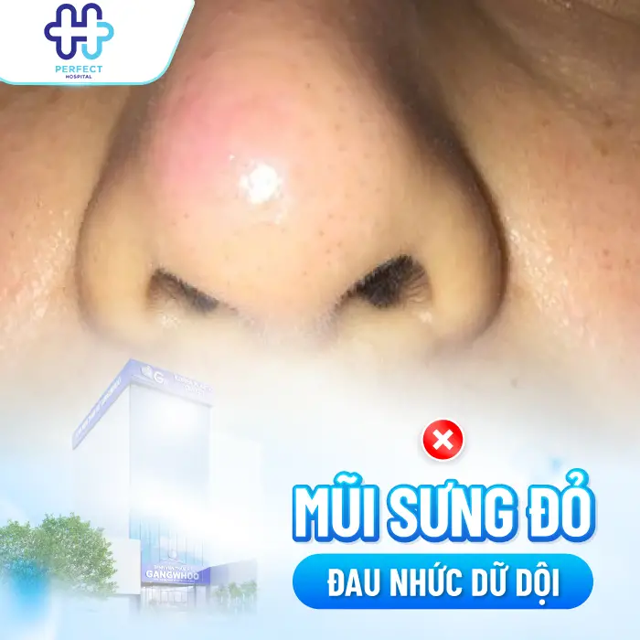 Nâng Mũi 1 Tháng Vẫn Còn Sưng Có Bình Thường Không? Cách Xử Lý