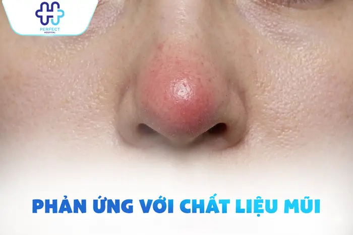 Nâng Mũi 1 Tháng Vẫn Còn Sưng Có Bình Thường Không? Cách Xử Lý