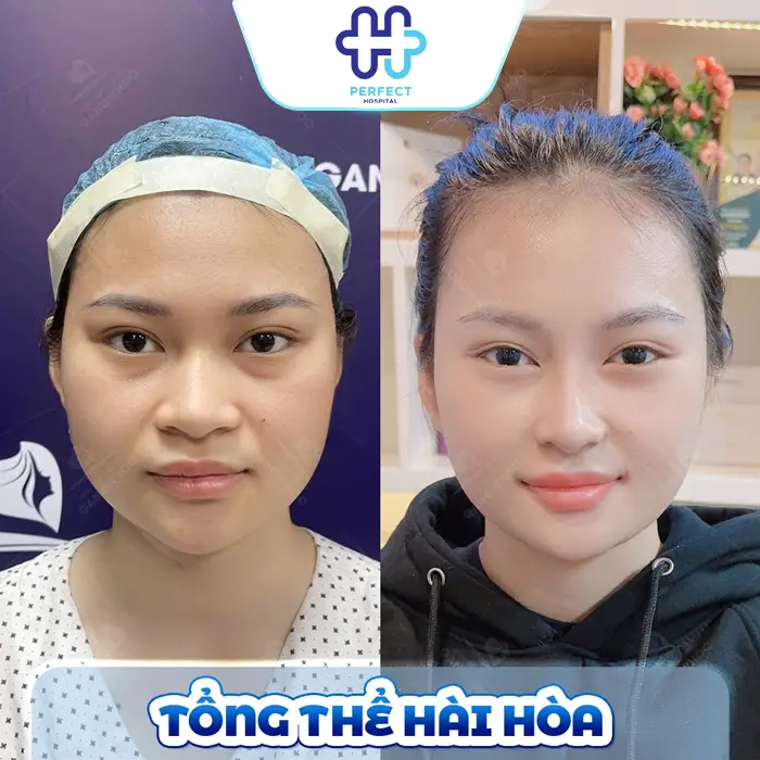 Nâng Mũi Model 2D Hàn Quốc Là Gì? Có Nên Thực Hiện Không