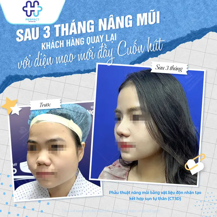 Nâng Mũi Model 2D Hàn Quốc Là Gì? Có Nên Thực Hiện Không