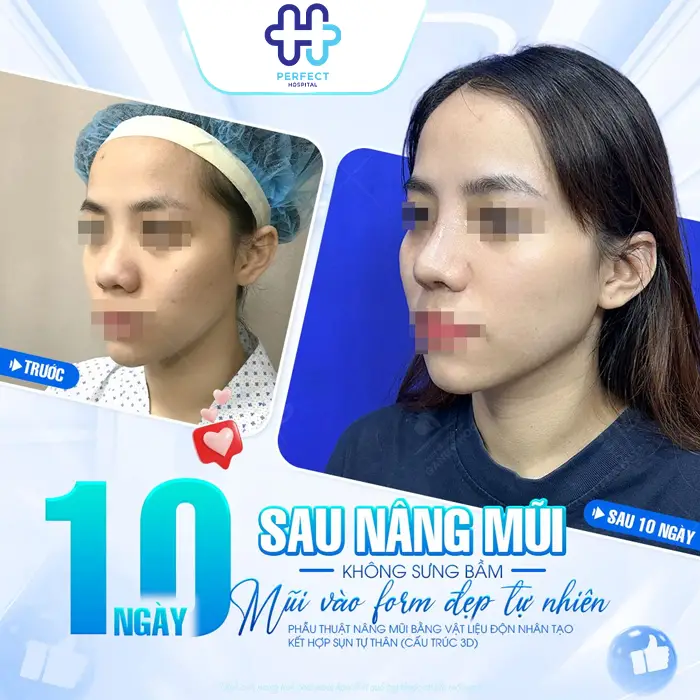 Nâng Mũi Model 2D Hàn Quốc Là Gì? Có Nên Thực Hiện Không
